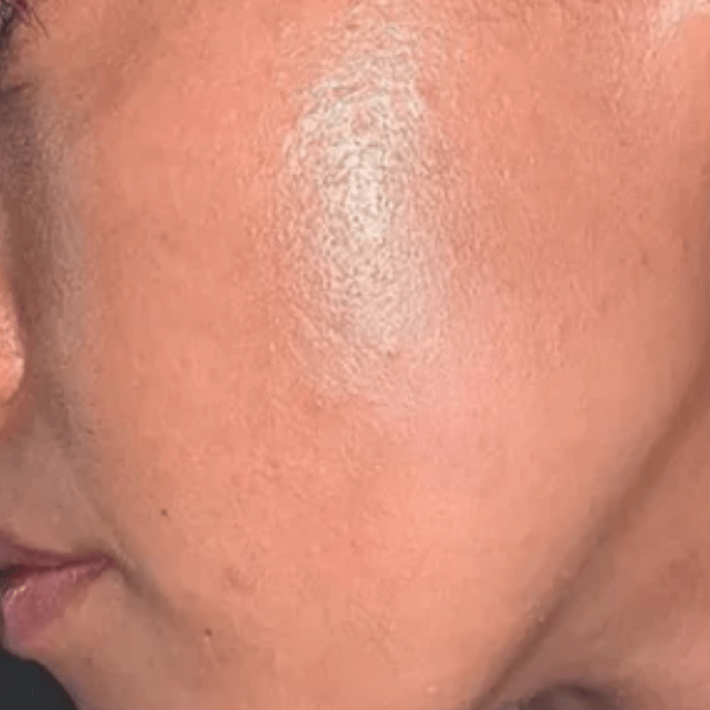 EpilSmooth™ - Épilation rapide du visage