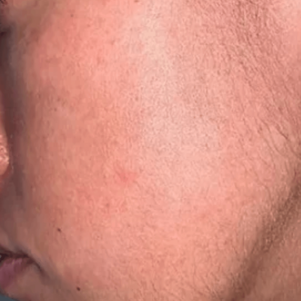EpilSmooth™ - Épilation rapide du visage